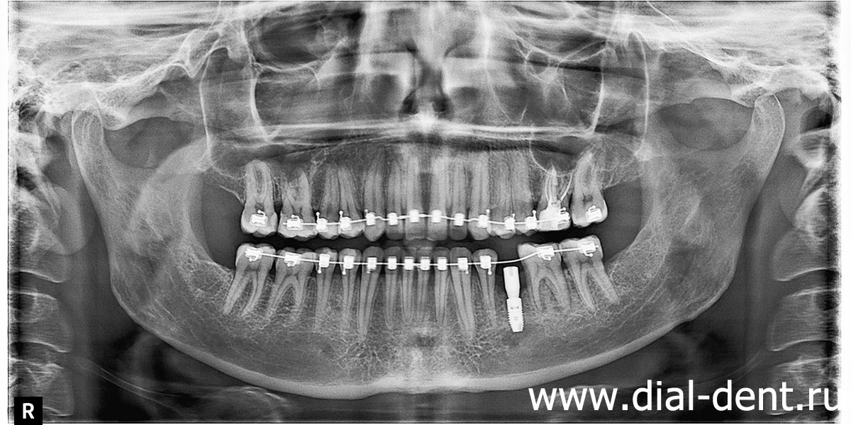 панорамный снимок зубов после имплантаци перед снятием брекетов