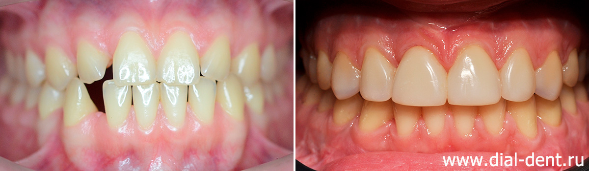 до и после хирургического исправления прикуса и реставрации зубов