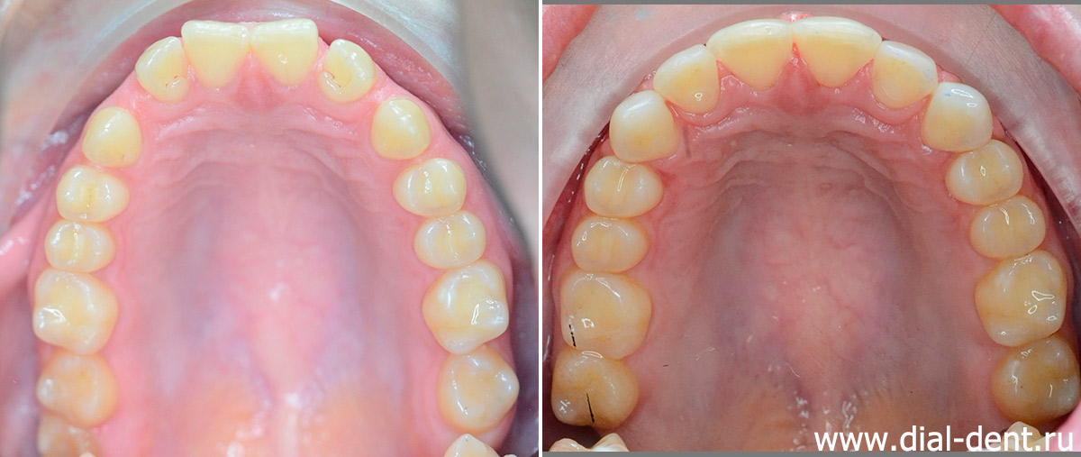 до и после хирургического исправления прикуса и реставрации верхних зубов