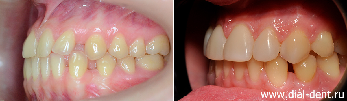прикус слева до и после ортодонтического лечения и реставрации зубов