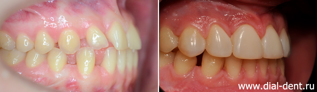 прикус справа до и после ортодонтического лечения и реставрации зубов