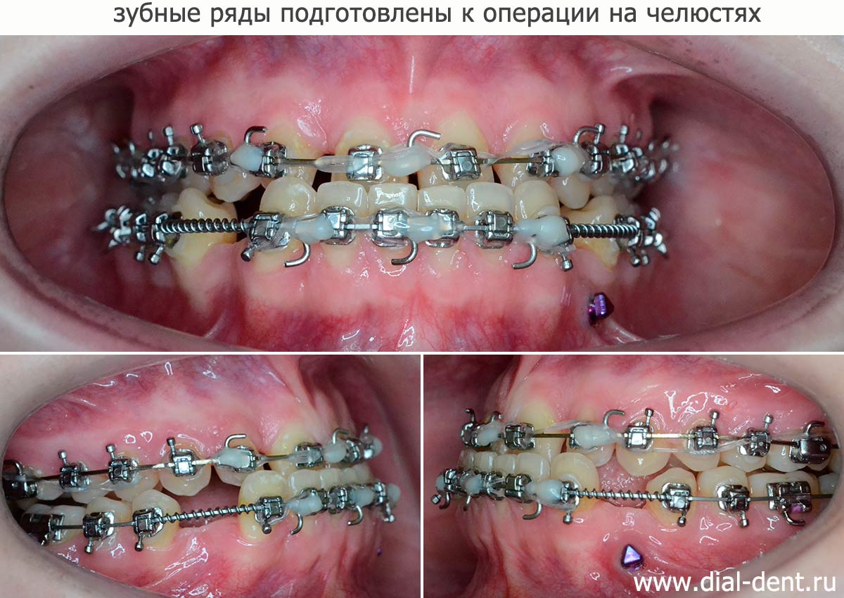 зубные ряды подготовлены к операции по изменению прикуса
