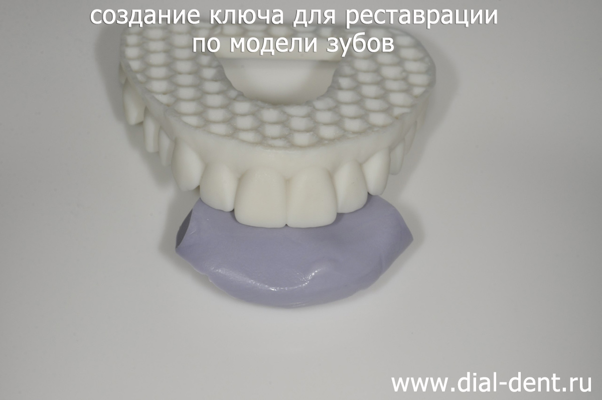 пример создания силиконового ключа для реставрации зубов