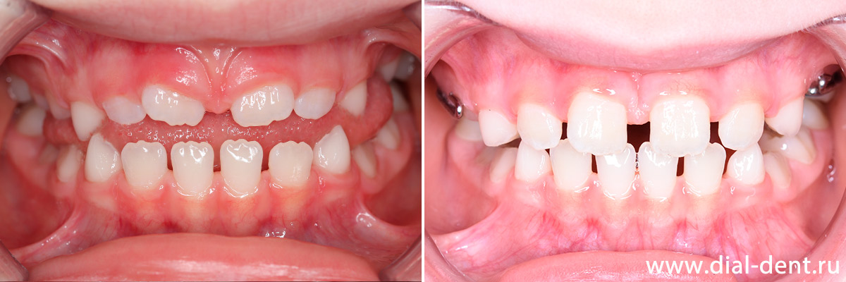 до и после ортодонтического лечения мезиального прикуса