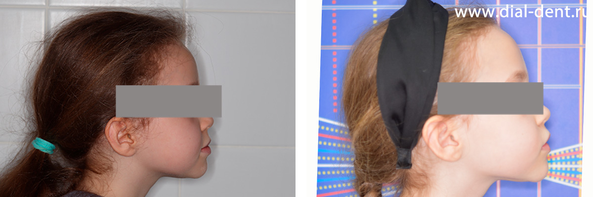 профиль до и после ортодонтического лечения мезиального прикуса