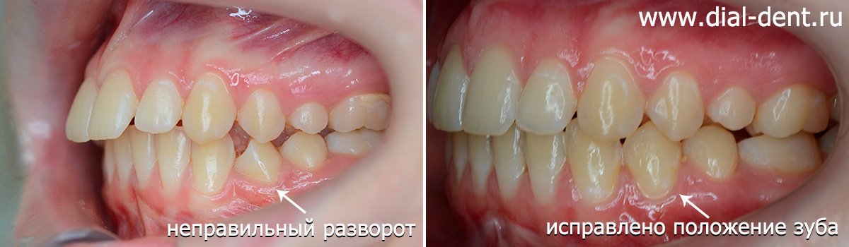 до и после исправления прикуса у подростка с ретинированным зубом