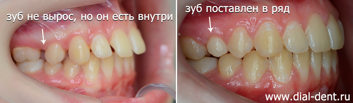 ретинированный зуб поставлен на место