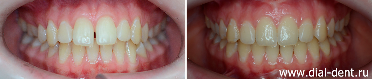 до и после исправления прикуса у подростка с ретинированным зубом