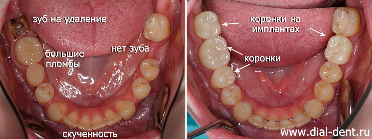 выравнивание зубов, имплантация и протезирование