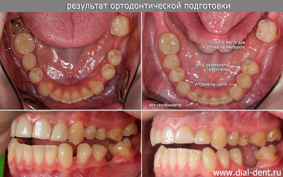 ортодонтическая подготовка к протезированию на импланте