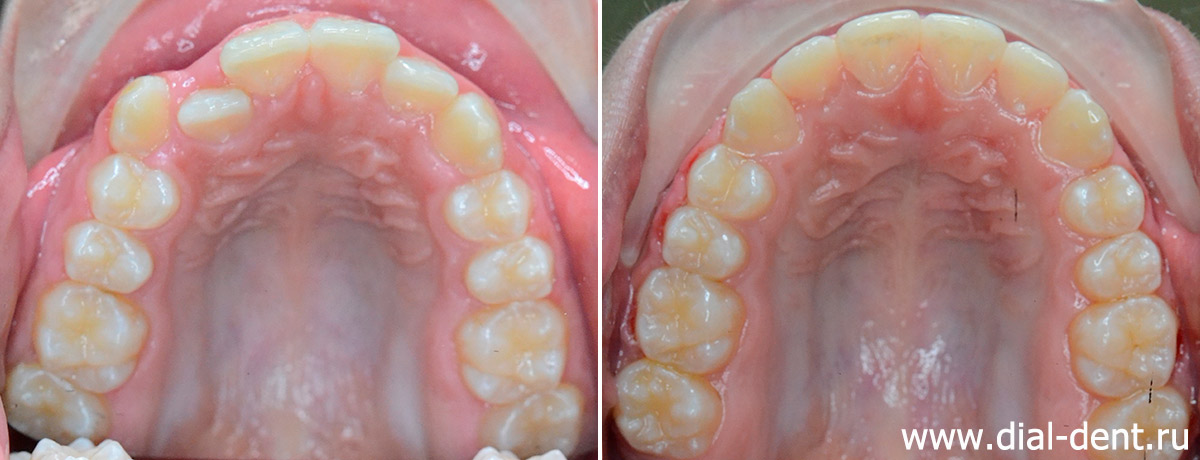 верхние зубы до и после исправления прикуса