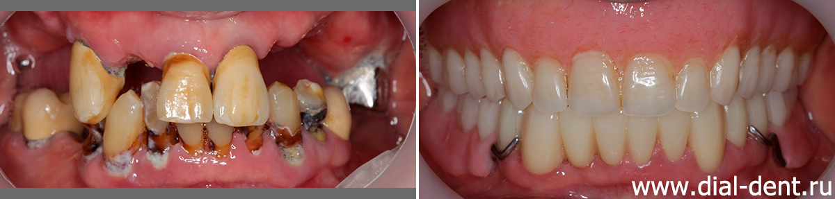 до и после лечения и протезирования зубов