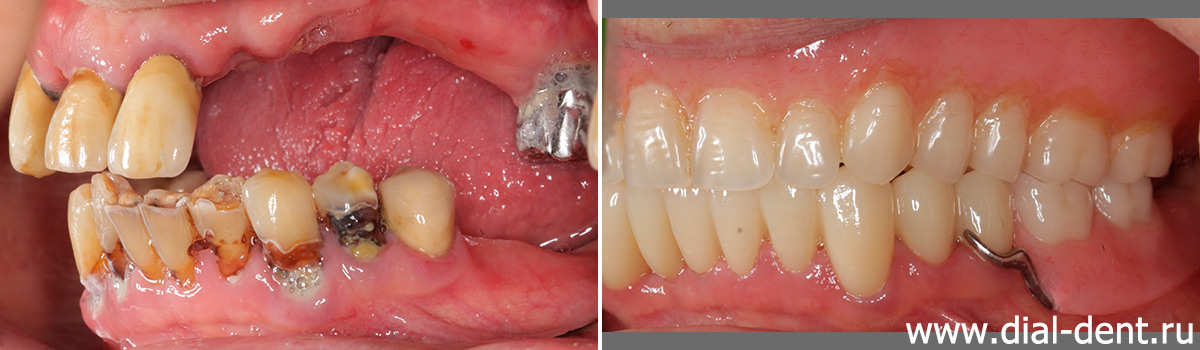 до и после лечения, удаления и протезирования зубов