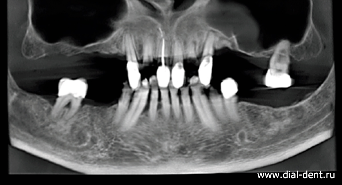 фрагмент компьютерной томограммы зубов до лечения