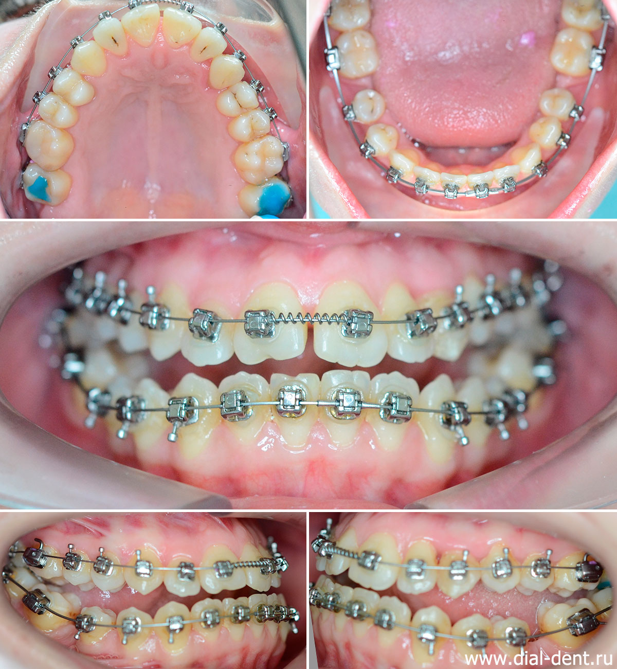 зубные ряды подготовлены к первой операции на верхней челюсти
