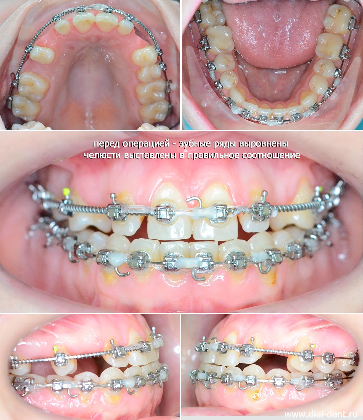 зубные ряды подготовлены к операции на челюстях