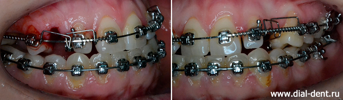 ретенированные зубы подключены к брекет-системе