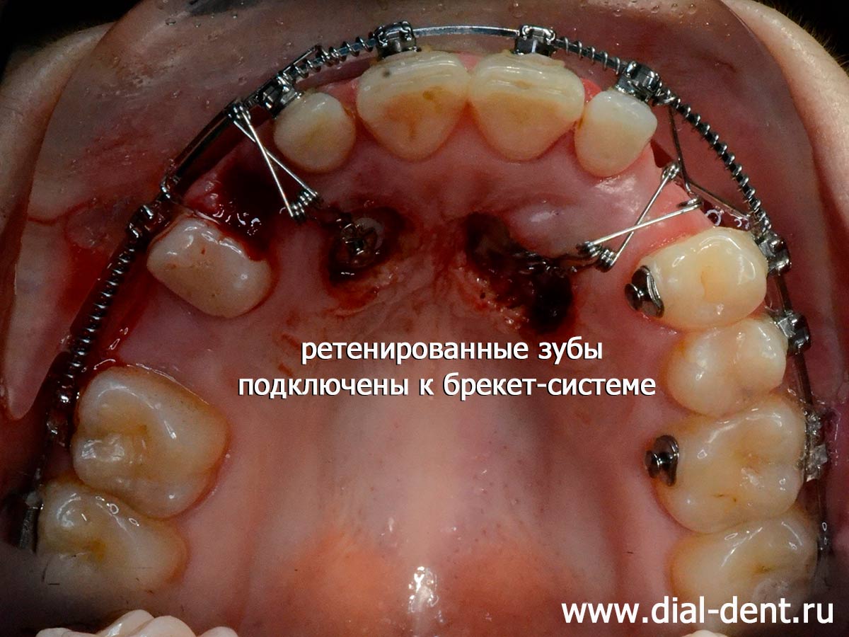 ретенированные зубы подключены к брекет-системе