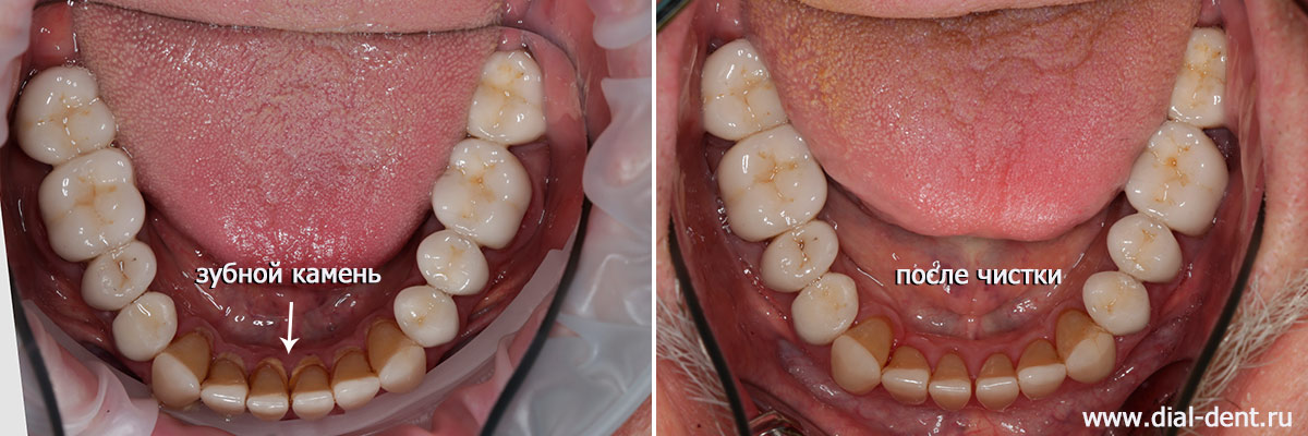 нижние зубы до и после чистки