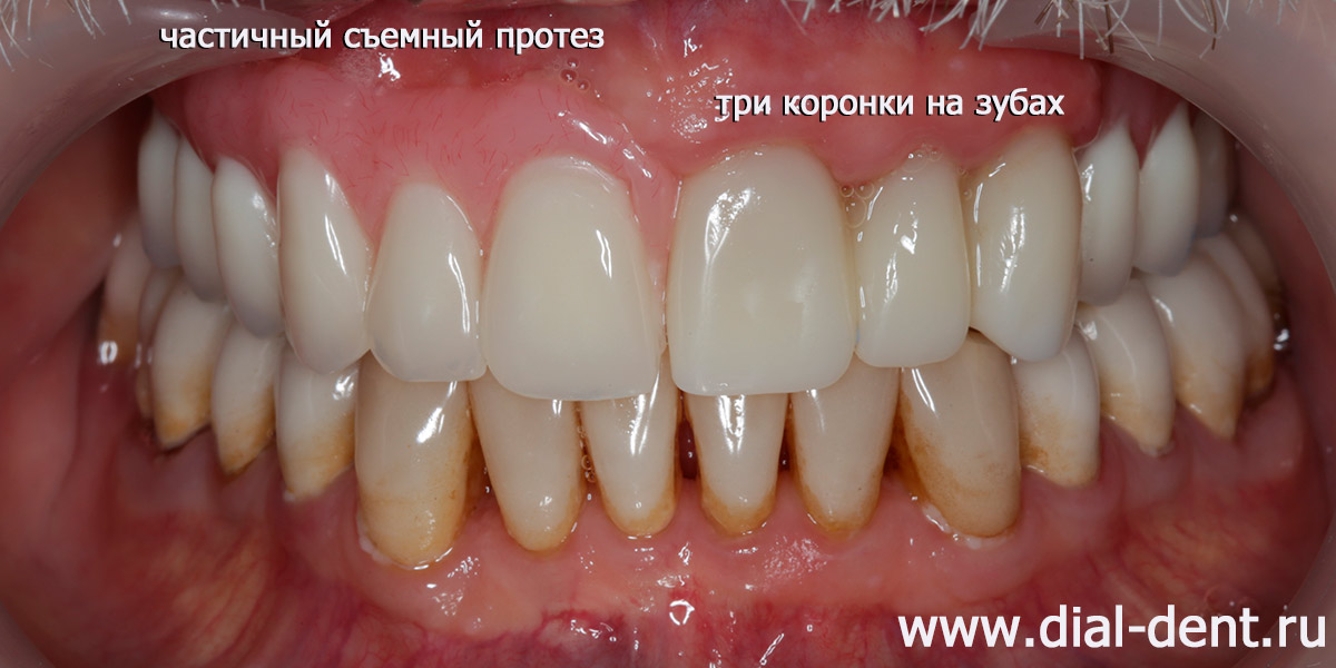 протезирование верхних зубов съемным протезом и коронками