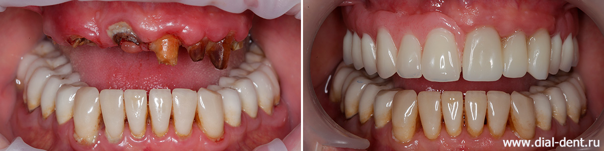 до и после протезирования верхних зубов