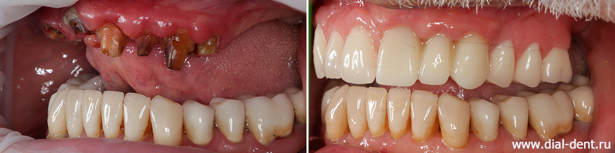 до и после протезирования верхних зубов