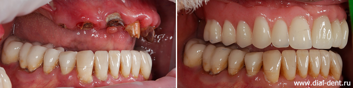 до и после протезирования верхних зубов