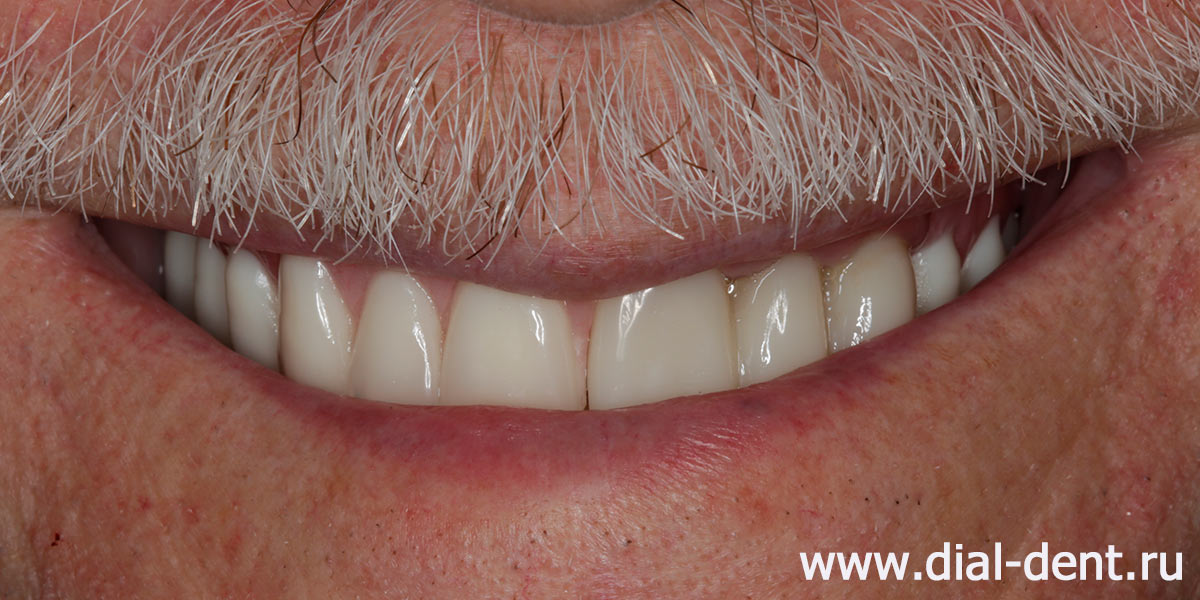 временный съемный протез верхних зубов и коронки на трех зубах