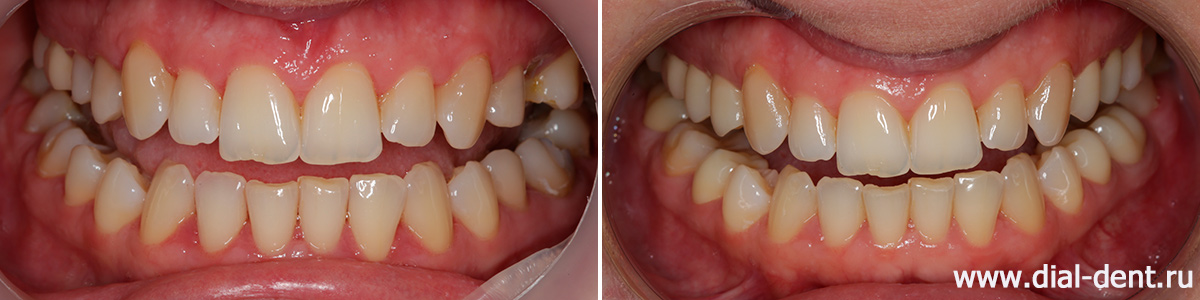до и после лечения и протезирования жевательных зубов
