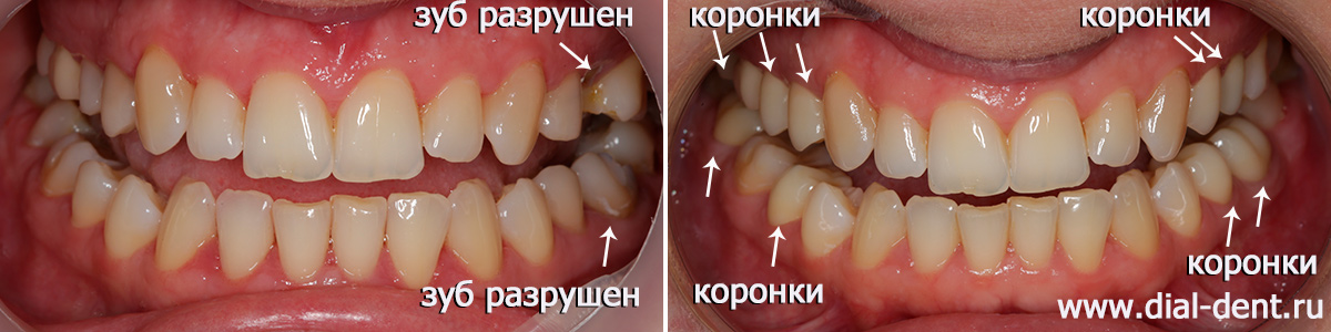 лечение и протезирование жевательных зубов