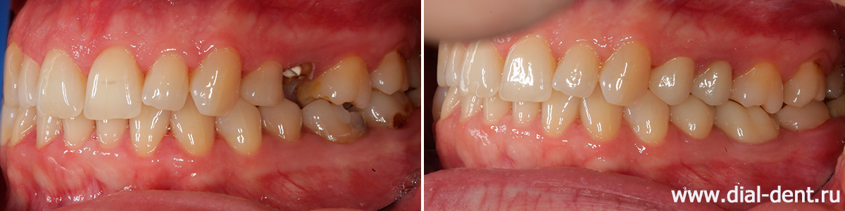 лечение и протезирование жевательных зубов