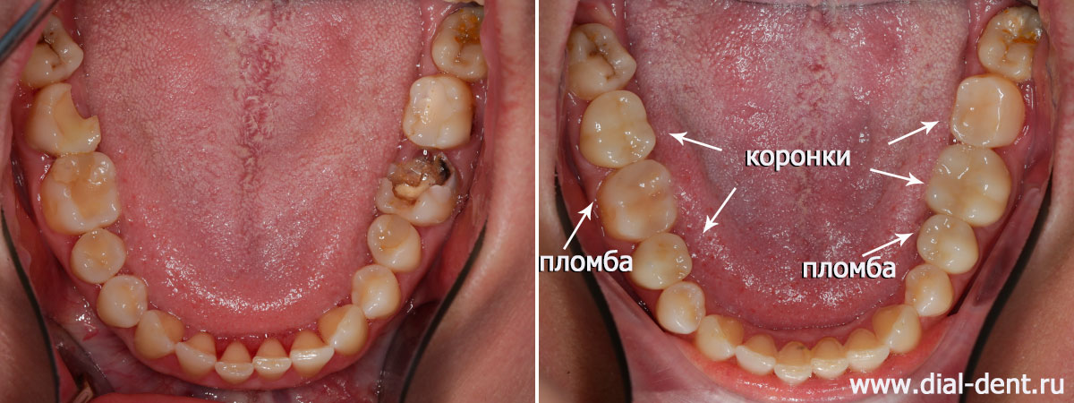 лечение зубов с микроскопом и протезирование жевательных зубов керамикой