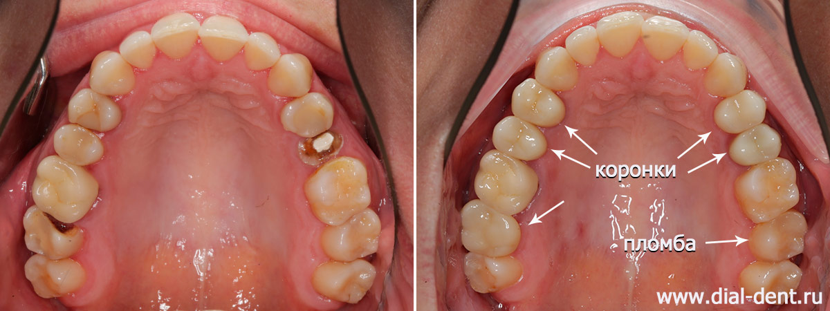 лечение зубов с микроскопом и протезирование жевательных зубов керамикой