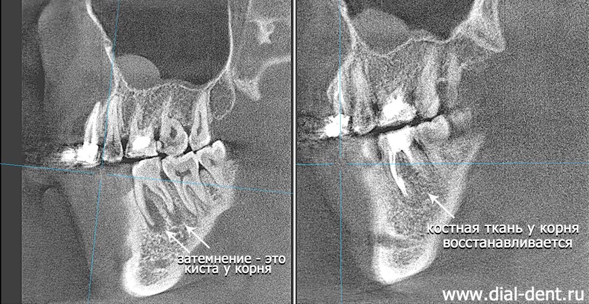киста зуба до и после лечения с микроскопом