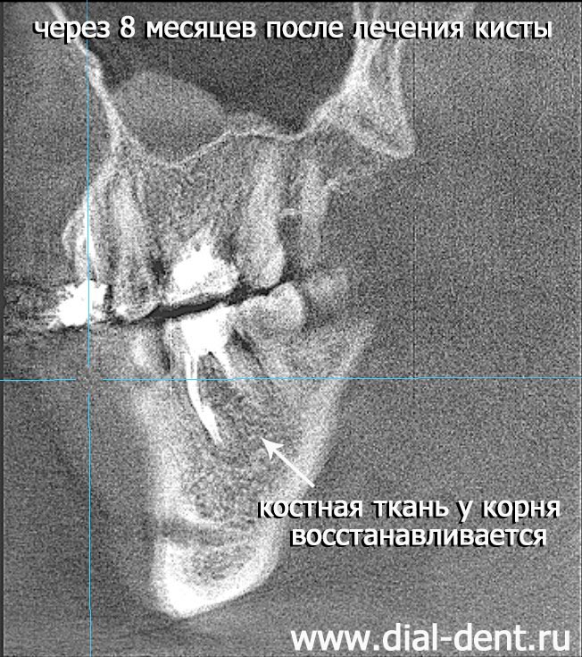 через 8 месяецв после лечения кисты зуба кость восстанавливается