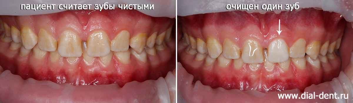 очищен один зуб, чтобы пациент увидел разницу