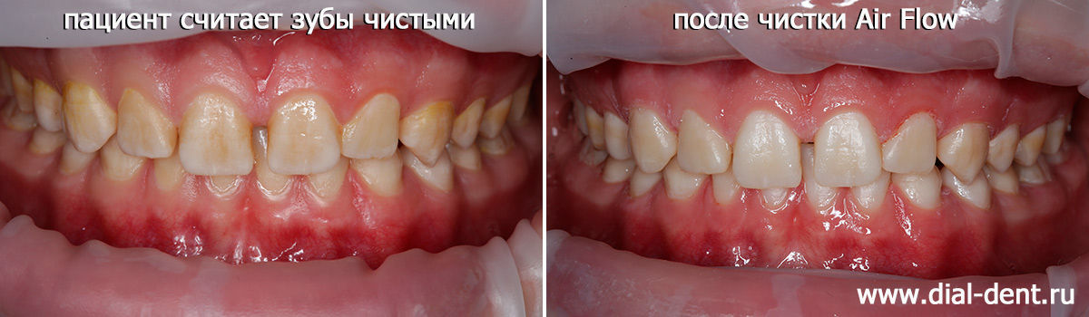 зубы до и после профессиональной гигиены