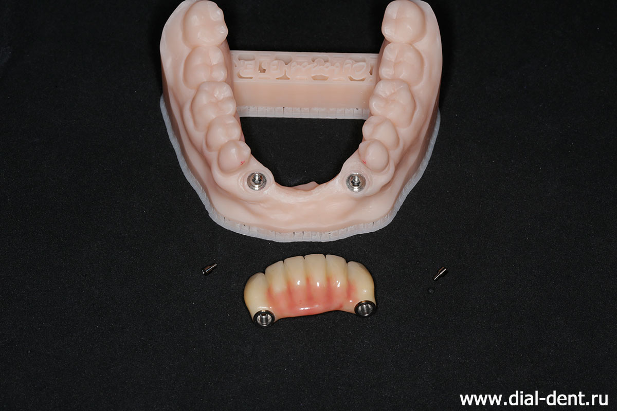 мостовидный протез передних нижних зубов