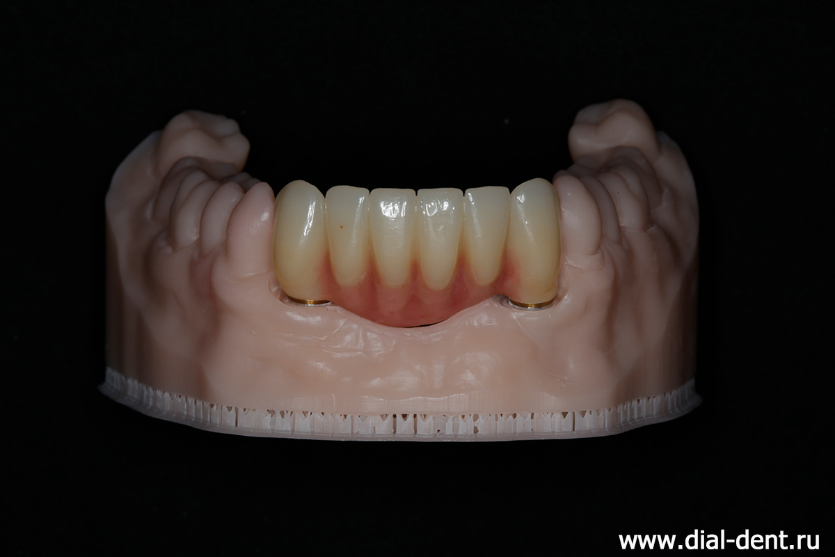керамический протез нижних передних зубов