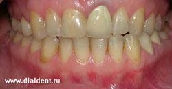 желтые зубы, металлокерамическая коронка на переднем зубе
