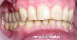 вид после протезирования зубов справа