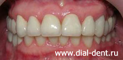 общий вид после протезирования и реставрации зубов