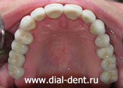 протезирование зубов, реставрация зубов