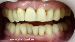 реставрация сломанного зуба и лечение зубов