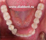 протезирование зубов нижней челюсти окончено
