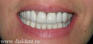 протезирование зубов, чистка и отбеливание зубов