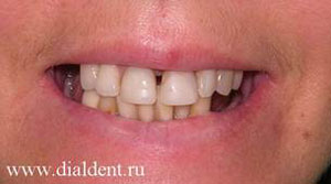 улыбка до протезирования зубов