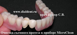 зубной кмень и зубной налет отчищены в клинике "Диал-Дент"
