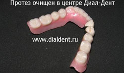 зубной кмень и зубной налет отчищены в клинике "Диал-Дент"