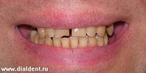 щель между зубами, неровные края зубов